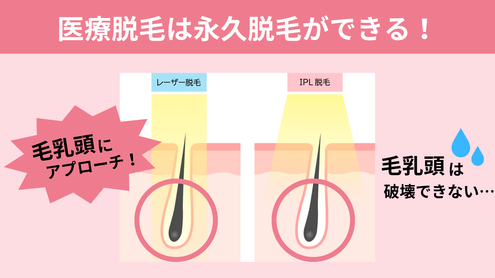 ヒゲの医療脱毛は永久脱毛ができる